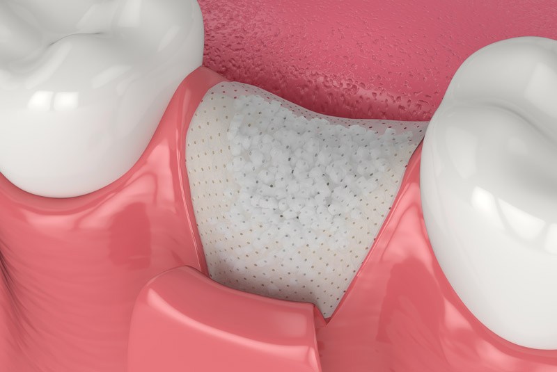 Bone grafting example model