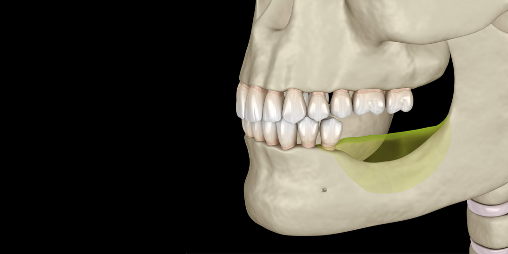 Bone loss example model