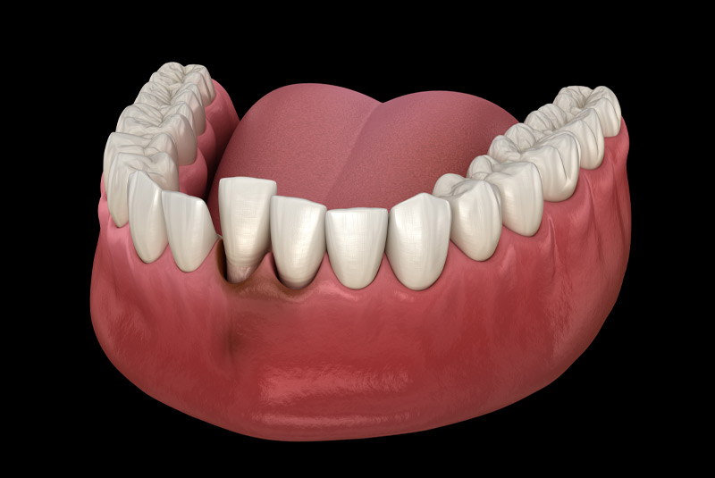 Dental trauma example model