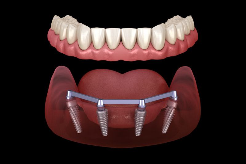 Implant supported dentures example model