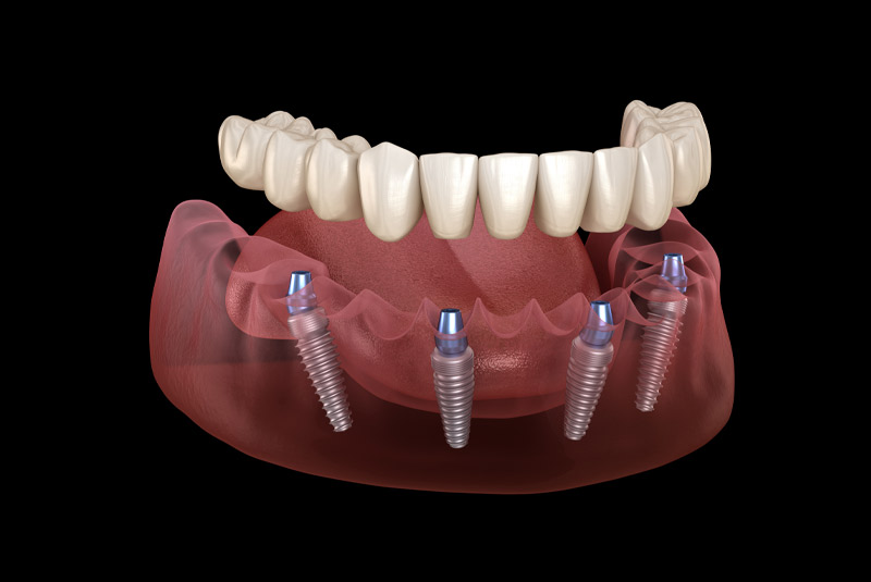 Full Mouth Dental Implants example model