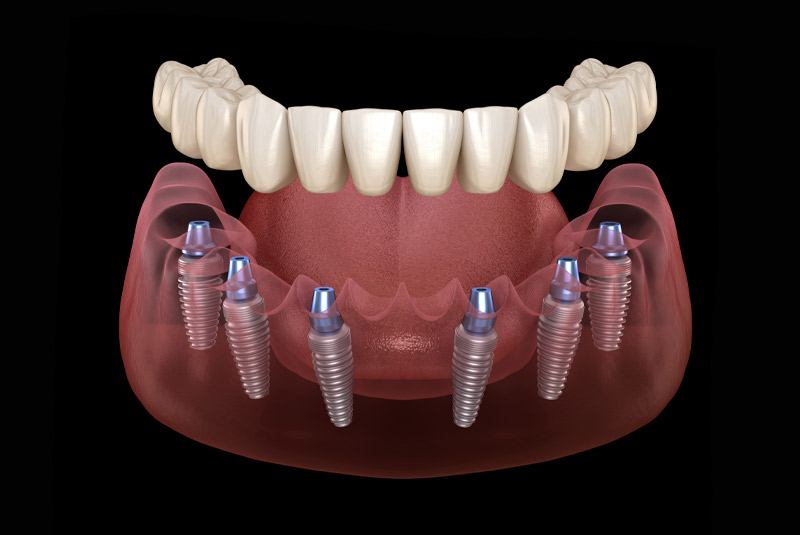 Full Mouth Dental Implants example model