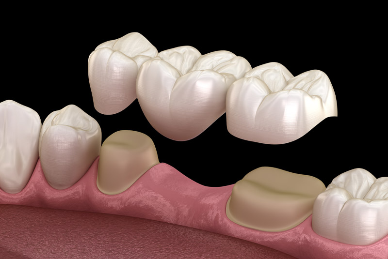 Dental bridge example.