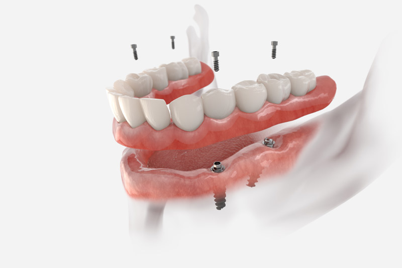 Implant supported dentures example model