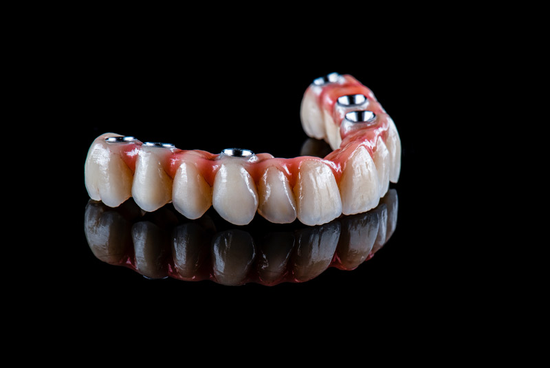 Full Arch Dental Implants