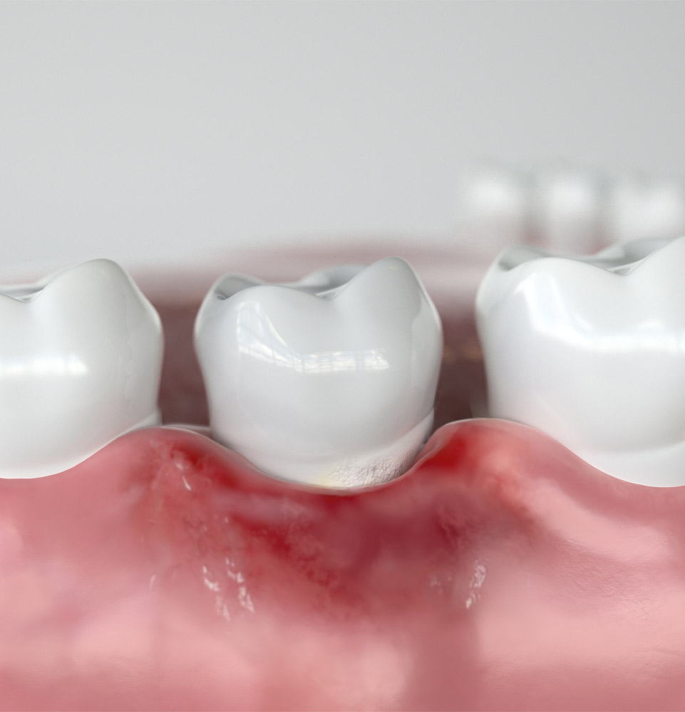 Gum problems example model