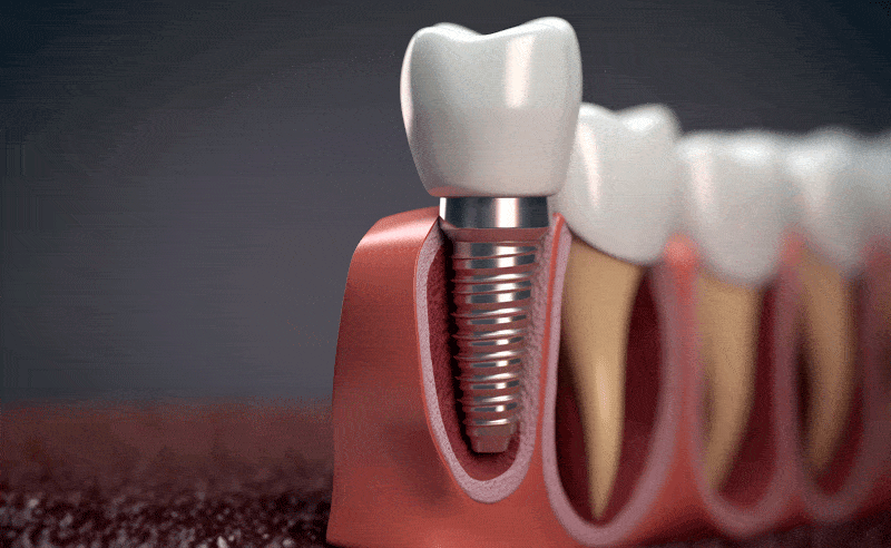 Medically accurate 3D illustration of human teeth and Implant concept.