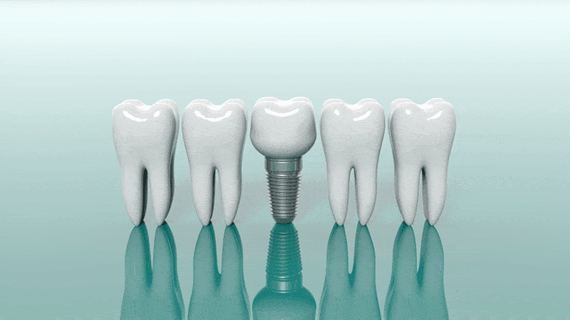 3d model of 4 teeth with a dental implant in the middle of them.
