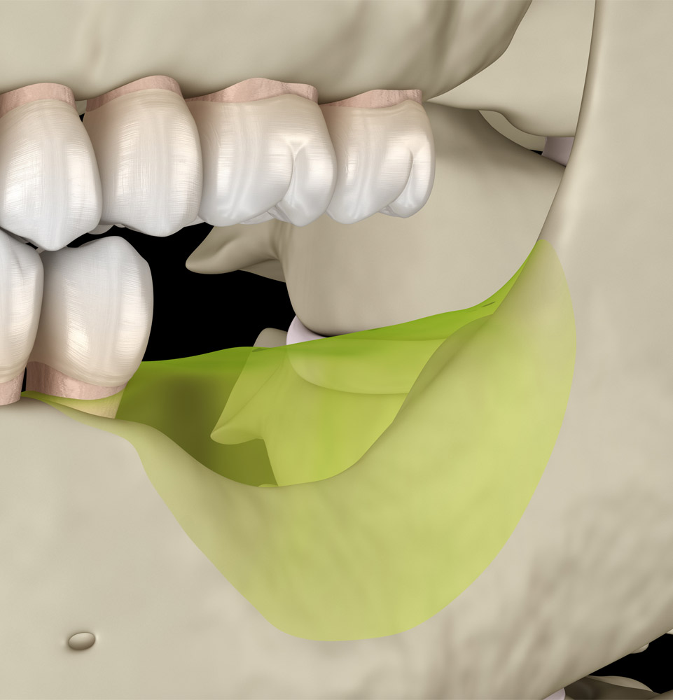 Bone Augmentation example model