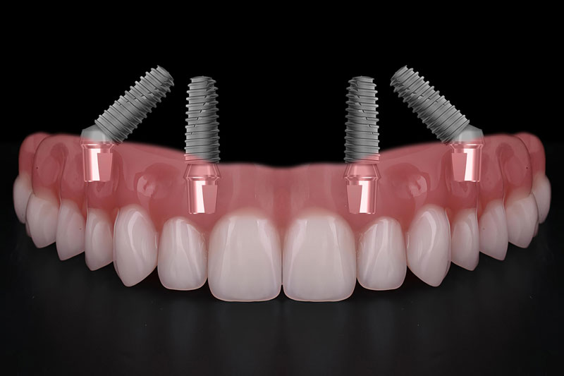 all on 4 dental implants with a full arch spanning across it