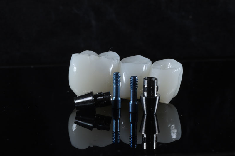 a dental implant bridge