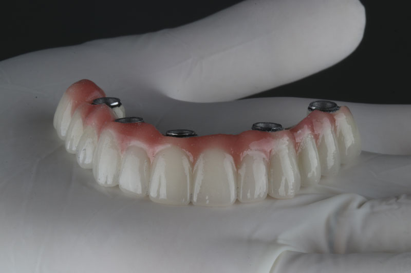a full arch implant model with teeth going across it and holes for implants to be placed